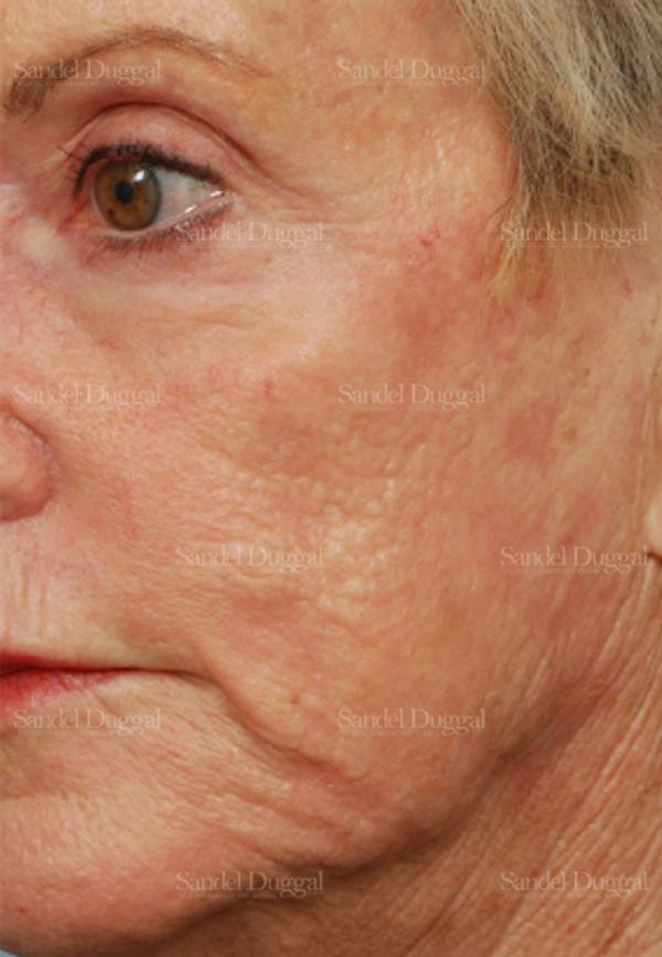 Laser Skin Resurfacing after, case 2963