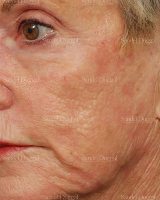Laser Skin Resurfacing after, case 2963