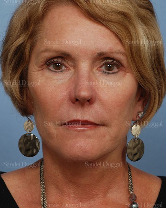 Facelift after, case 2697