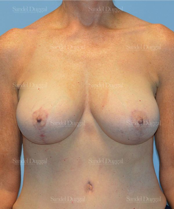 Breast Augmentation with Lift after, case 3372
