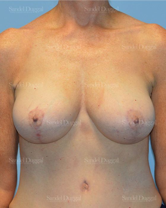 Breast Augmentation with Lift after, case 3372