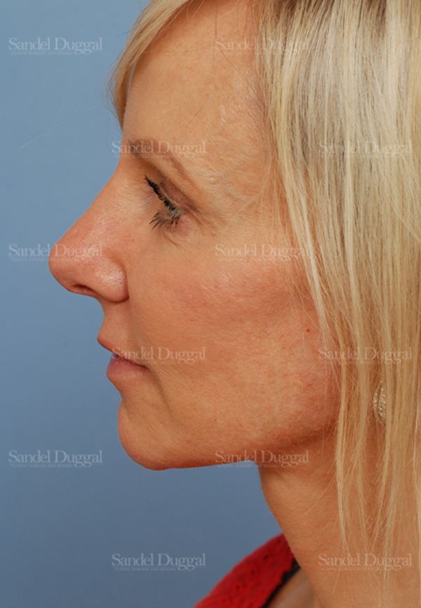 Mini Facelift after, case 2576
