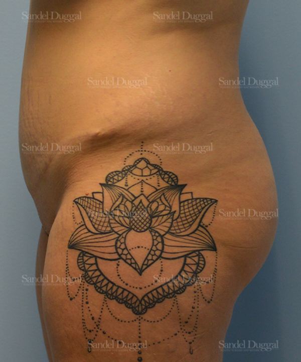 Liposuction — Legs & Flanks before, case 2515