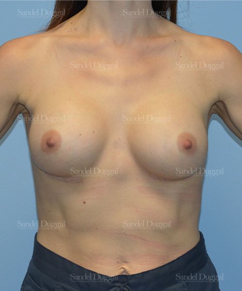 Breast Augmentation after, case 752