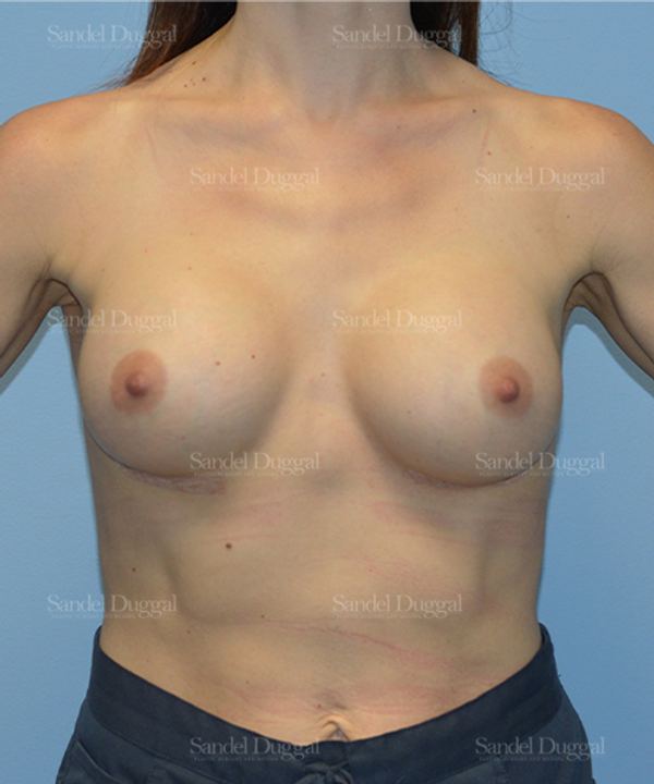 Breast Augmentation after, case 752