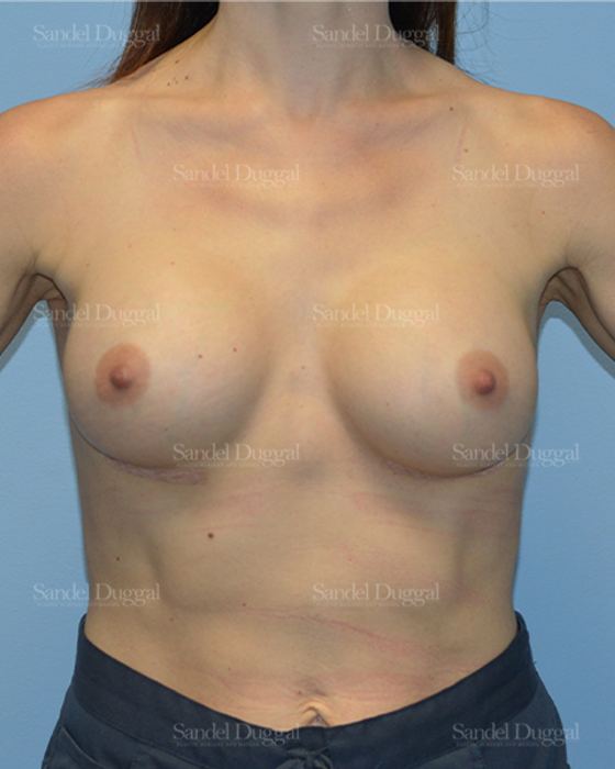 Breast Augmentation after, case 752