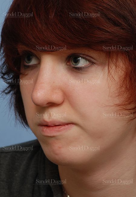 Rhinoplasty after, case 2826