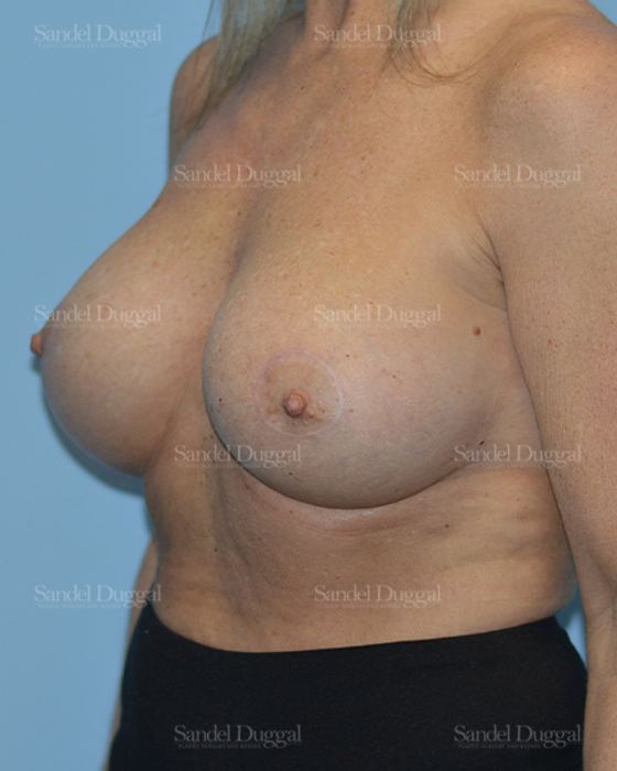 Breast Augmentation with Lift after, case 3386