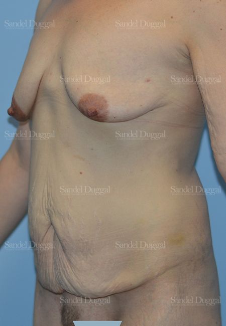 Mommy Makeover before, case 2211