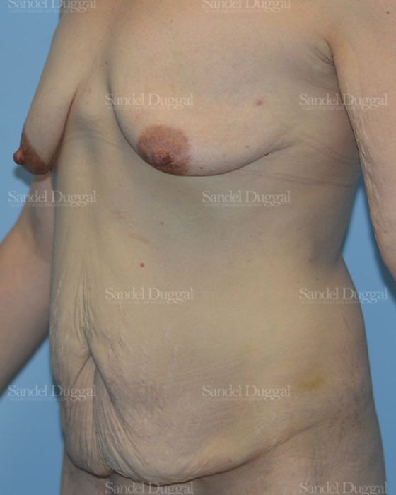 Mommy Makeover before, case 2211