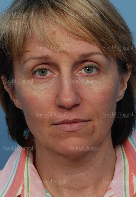 Rhinoplasty before, case 2855