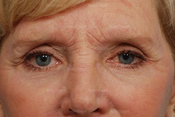 Eyelid Rejuvenation after, case 1946