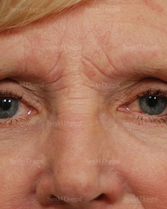 Eyelid Rejuvenation after, case 1946