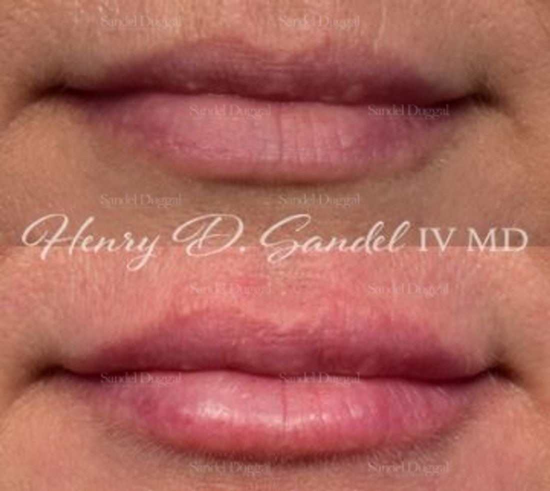 Lip Augmentation / Lip Lift before and after, case 4399