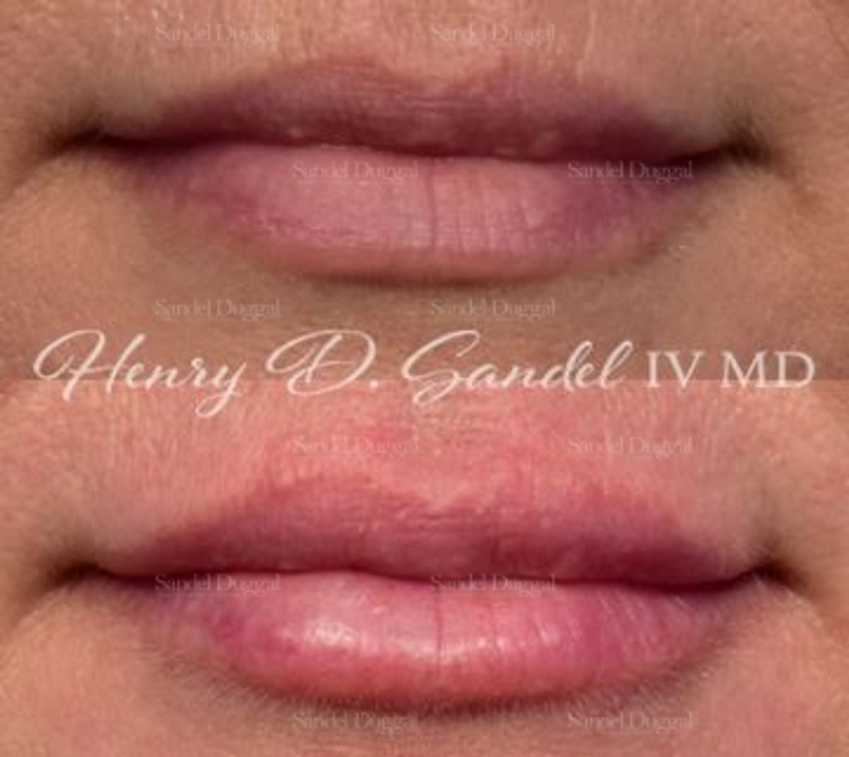 Lip Augmentation / Lip Lift before and after, case 4399