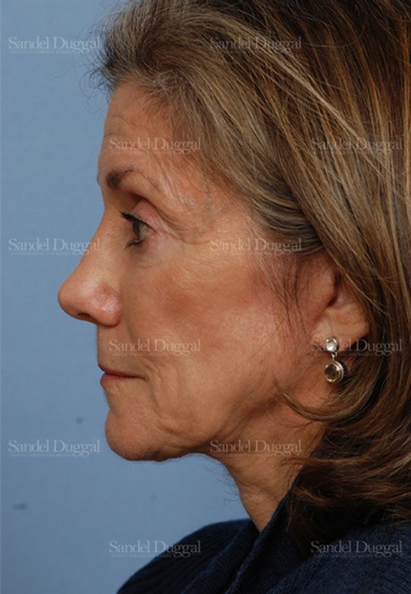 Rhinoplasty after, case 2845