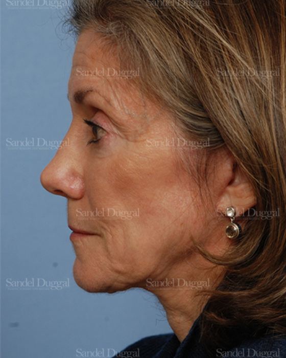 Rhinoplasty after, case 2845