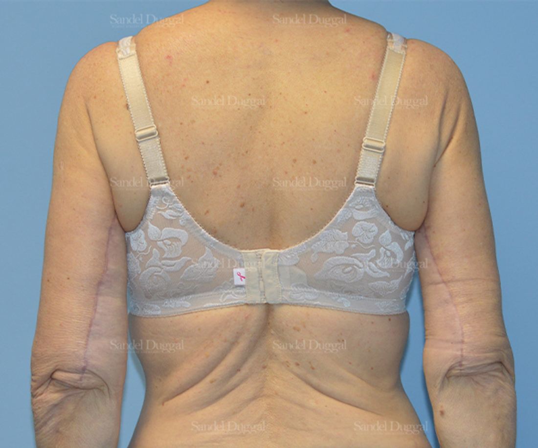 Brachioplasty before and after, case 2150