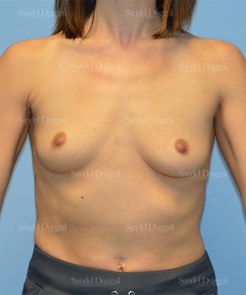 Breast Augmentation before, case 752