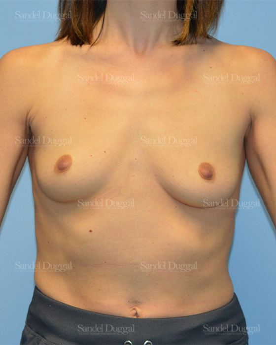 Breast Augmentation before, case 752