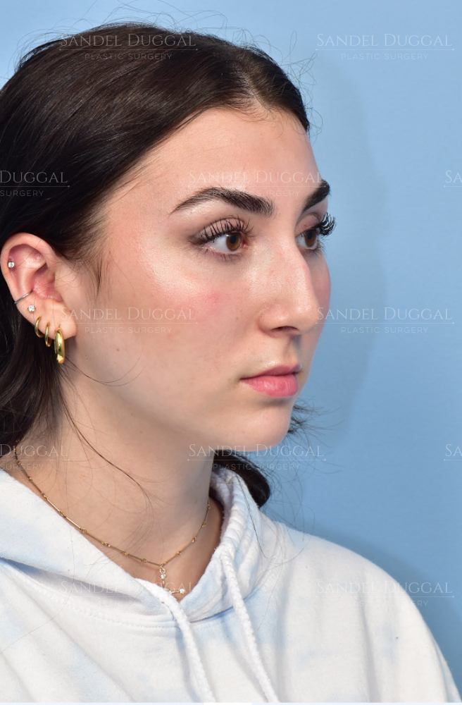 Rhinoplasty before, case 6002