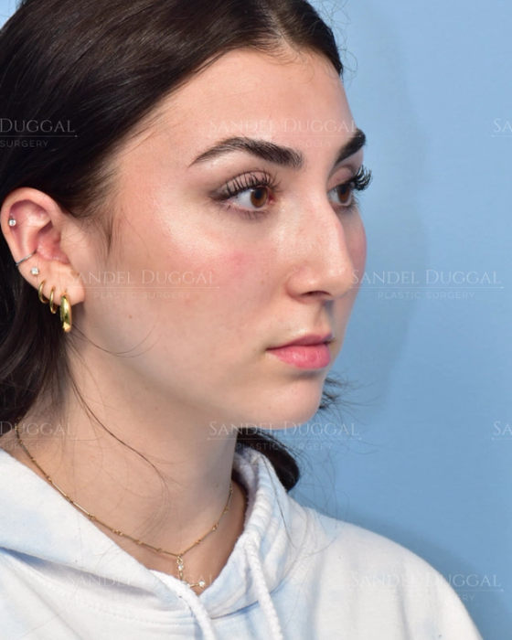 Rhinoplasty before, case 6002