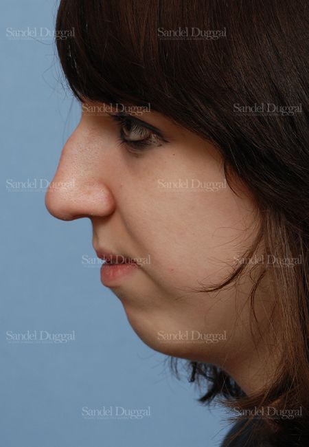 Rhinoplasty before, case 2826