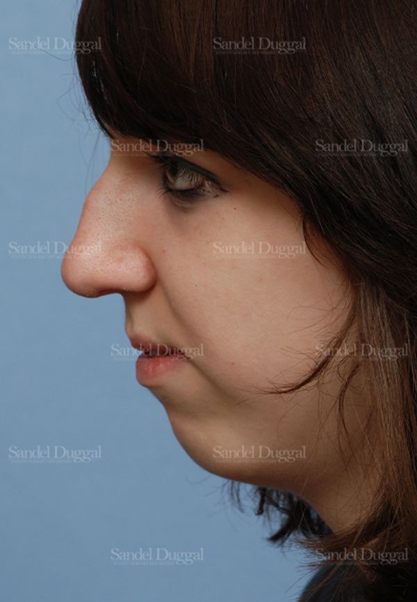 Rhinoplasty before, case 2826