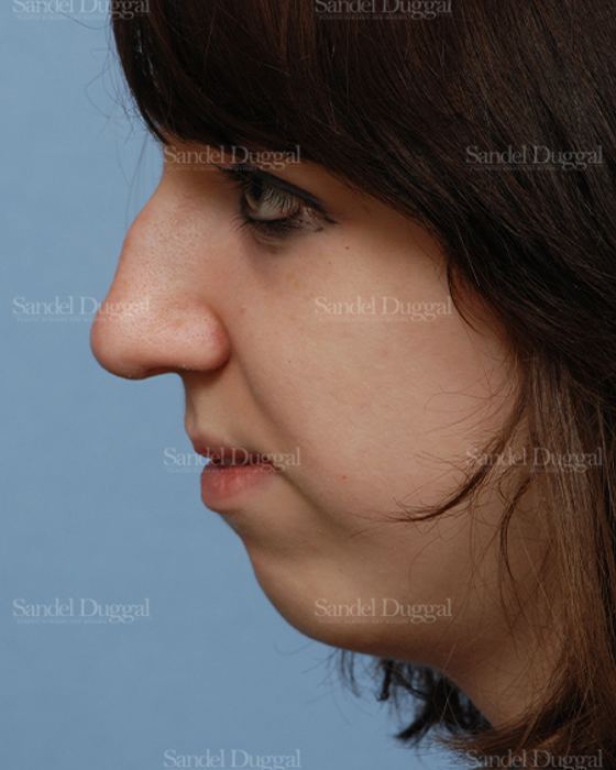 Rhinoplasty before, case 2826