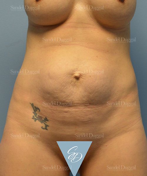 Tummy Tuck before, case 1540