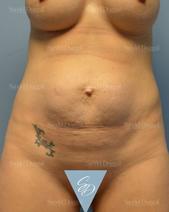 Tummy Tuck before, case 1540