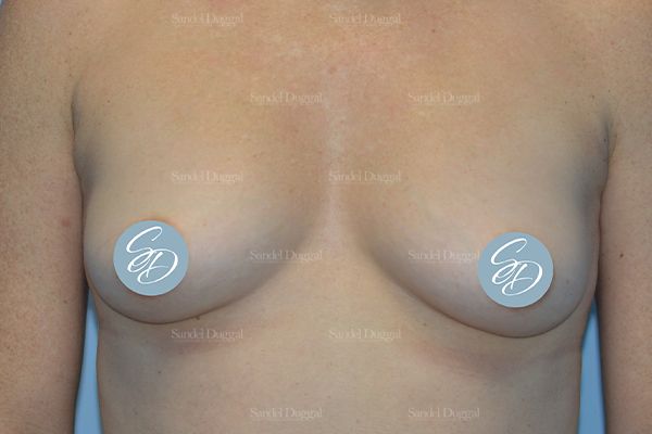 Liposuction — Bra Roll after, case 2492