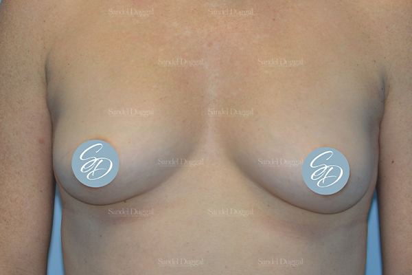 Liposuction — Bra Roll after, case 2492