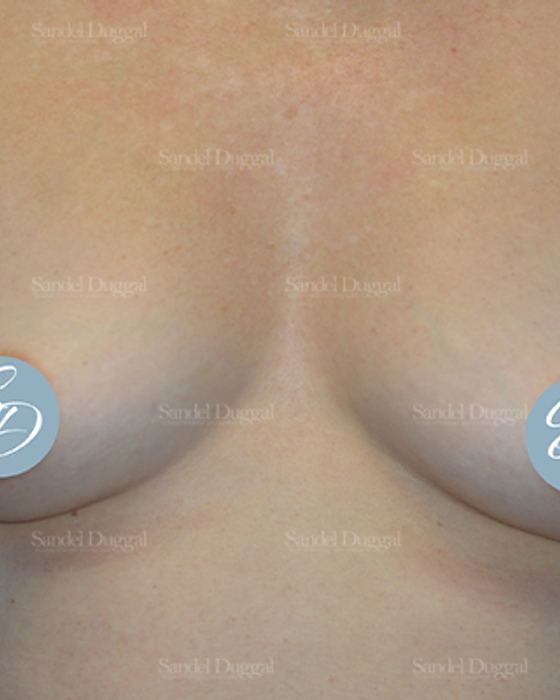 Liposuction — Bra Roll after, case 2492