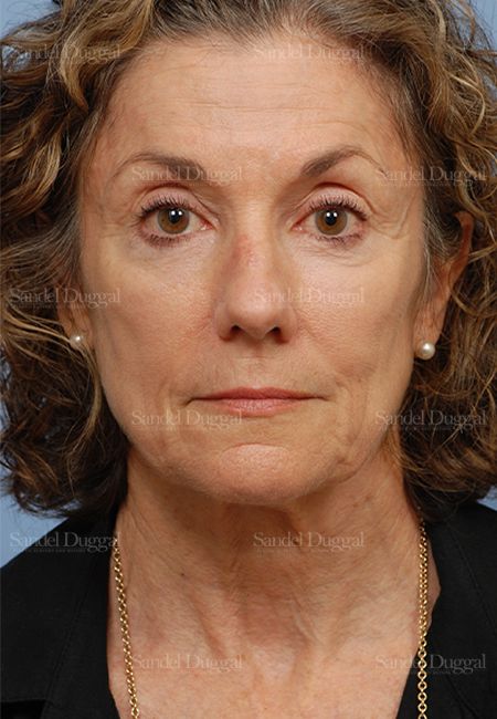 Rhinoplasty before, case 2845