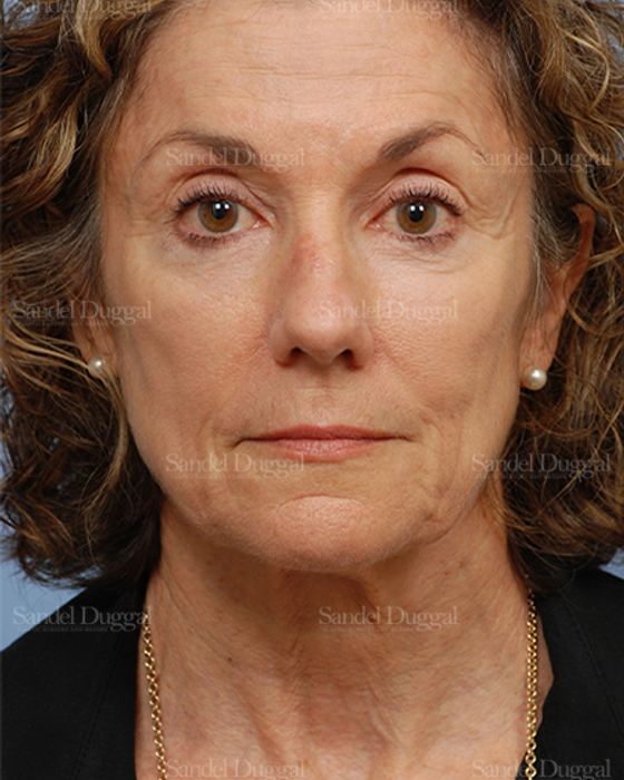 Rhinoplasty before, case 2845