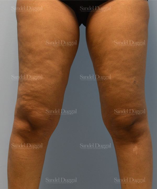 Liposuction — Legs & Flanks before, case 2537
