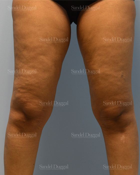 Liposuction — Legs & Flanks before, case 2537