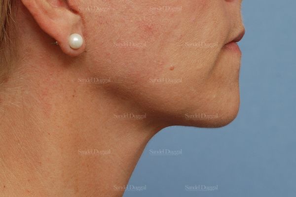 Mini Facelift after, case 2579
