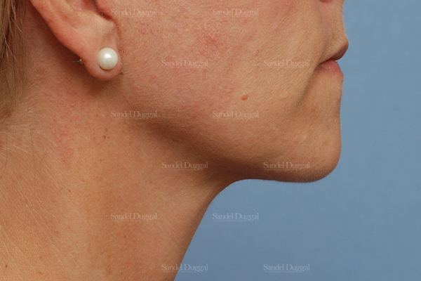 Mini Facelift after, case 2579