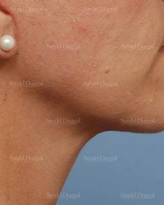 Mini Facelift after, case 2579