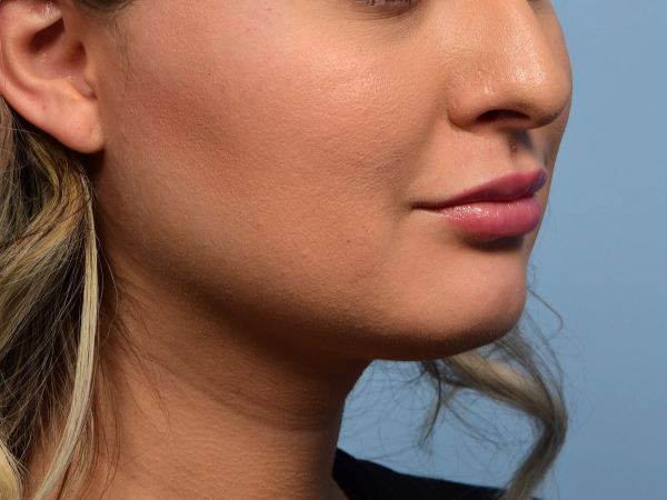 Buccal Fat Reduction before, case 6005