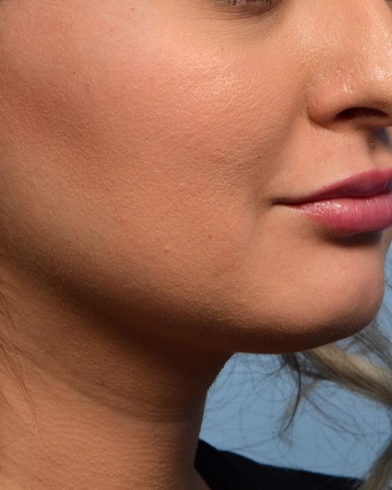 Buccal Fat Reduction before, case 6005