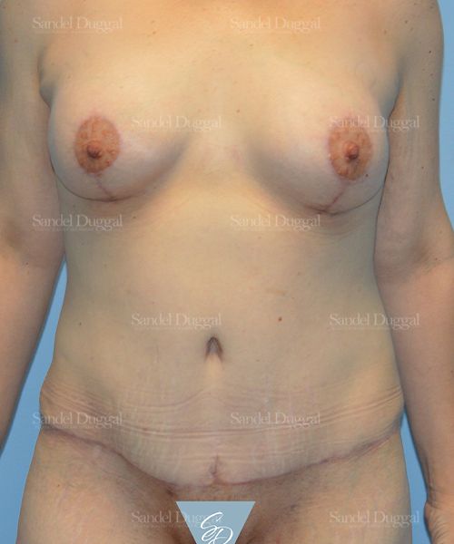 Tummy Tuck after, case 1615
