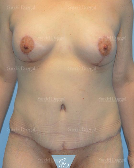 Tummy Tuck after, case 1615