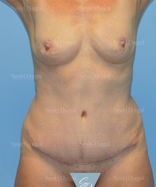 Tummy Tuck after, case 1687