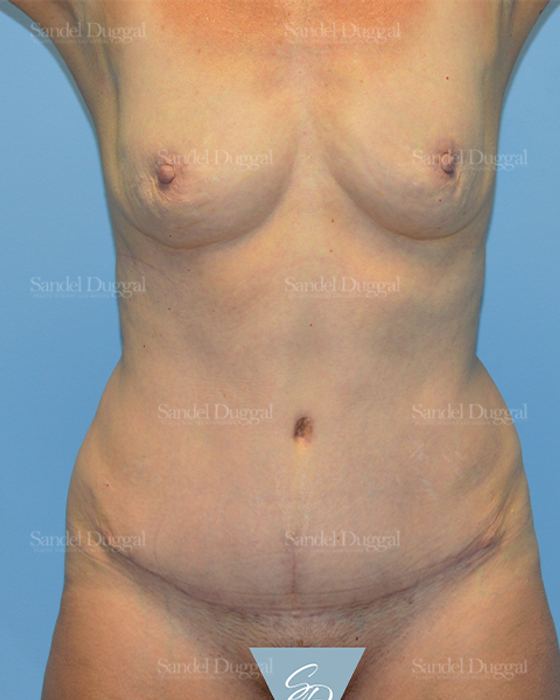 Tummy Tuck after, case 1687