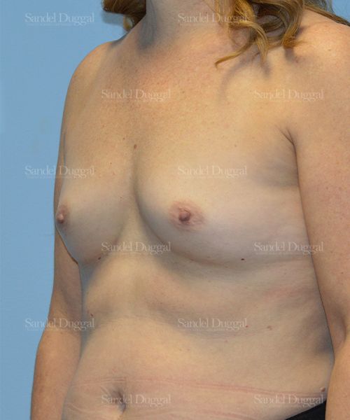 Breast Augmentation before, case 3094