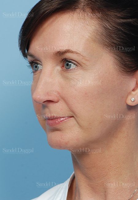 Facelift after, case 2647