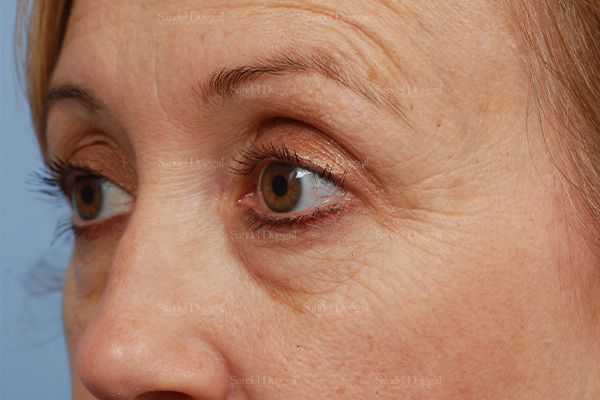 Eyelid Rejuvenation before, case 1917